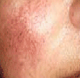 PDL VBeam patient before photo