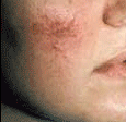 PDL VBeam patient before photo