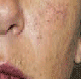 PDL VBeam patient before photo