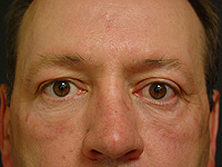 Liposculpture and Fat Transfer patient after photo