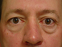 Liposculpture and Fat Transfer patient before photo