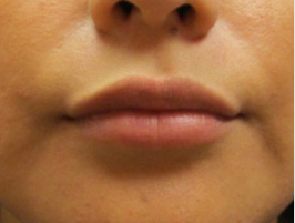 Restylane patient after photo