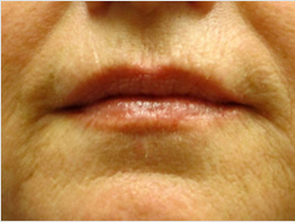 Restylane  patient after photo