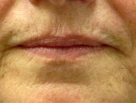 Restylane patient before photo