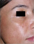Melasma patient after photo