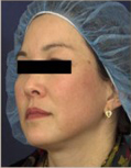 Melasma patient after photo