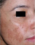 Melasma patient before photo