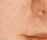 Microdermabrasion patient after photo