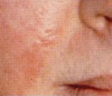 Microdermabrasion patient before photo
