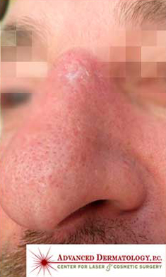 MOHS Skin Cancer Surgery patient after photo