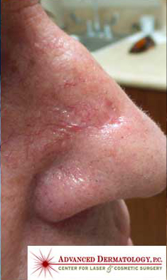 MOHS Skin Cancer Surgery patient after photo
