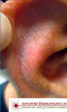 MOHS Skin Cancer Surgery patient after photo