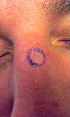 MOHS Skin Cancer Surgery patient before photo