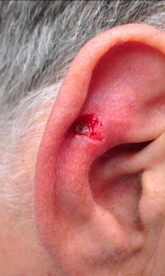 MOHS Skin Cancer Surgery patient before photo