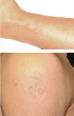 PicoSure patient after photo
