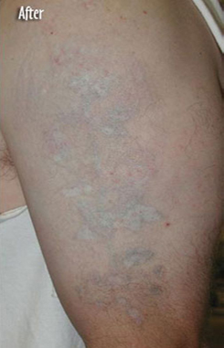 PicoSure patient after photo