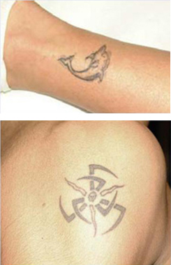 PicoSure patient before photo