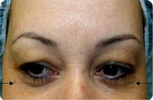 Pixel CO2 Laser patient before photo
