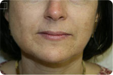 Pixel CO2 patient before photo