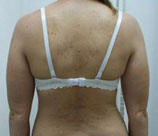 Psoriasis patient after photo