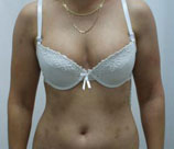 Psoriasis patient after photo