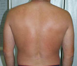 Psoriasis patient after photo