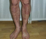 Psoriasis patient after photo