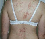 Psoriasis patient before photo