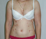Psoriasis patient before photo