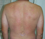 Psoriasis patient before photo