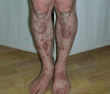 Psoriasis patient before photo
