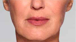 Restylane Refyne after photo
