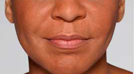 Restylane Refyne patient after photo