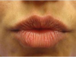 Restylane patient before photo