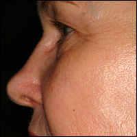 Skin Rejuvenation patient after photo
