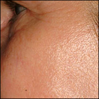 Skin Rejuvenation patient after photo