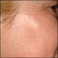 Skin Rejuvenation patient after photo