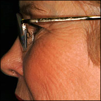 Skin Rejuvenation patient before photo