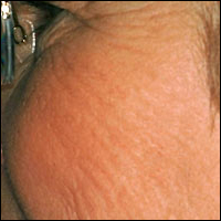 Skin Rejuvenation patient before photo