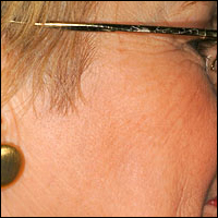 Skin Rejuvenation patient before photo