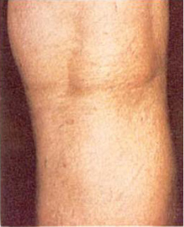 Spider Vein Treatment patient after photo