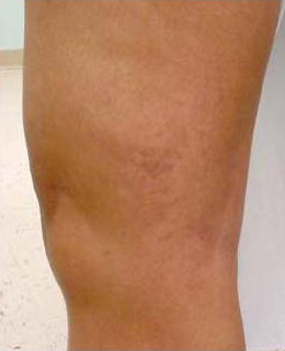 Spider Vein Treatment patient after photo