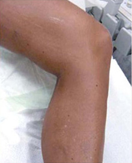 Spider Vein Treatment patient after photo