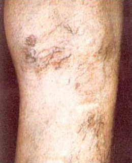 Spider Vein Treatment patient before photo