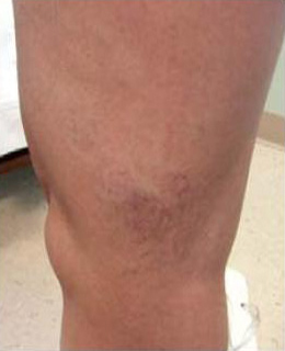 Spider Vein Treatment patient before photo