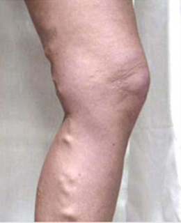 Spider Vein Treatment patient before photo