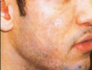 Scar Removal patient before photo