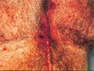 Scar Removal patient before photo