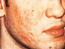 Scar Removal patient before photo