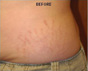Stretch Marks patient before photo